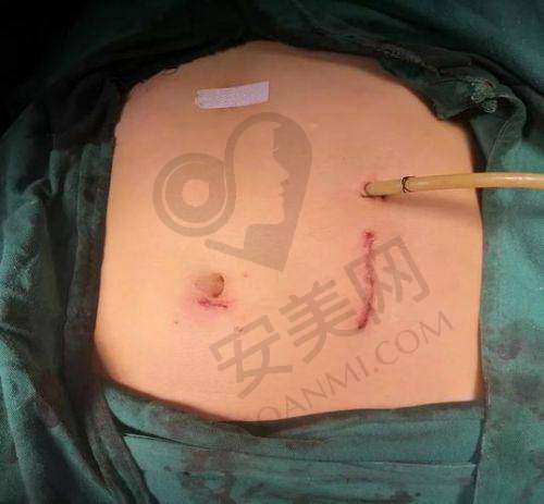 选择合肥韩美医院进行剖腹产疤痕修复有哪些优势？