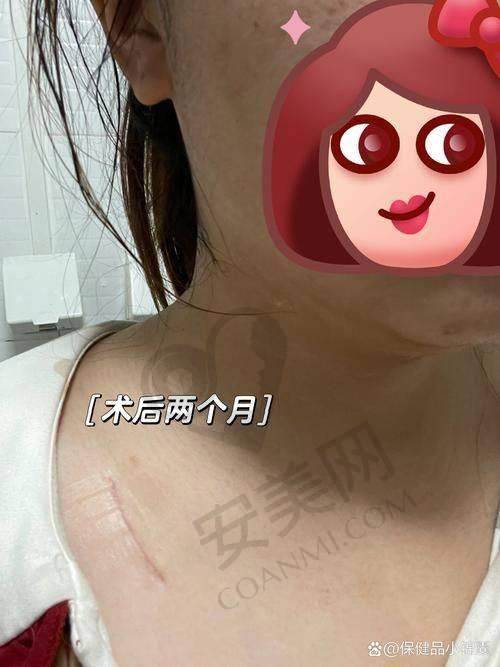 合肥韩美医院剖腹产疤痕修复的成效如何？