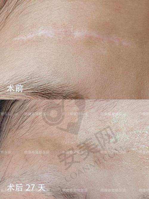 什么是剖腹产疤痕？
