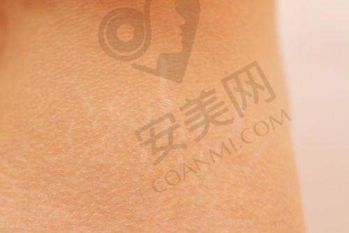 进行剖腹产疤痕修复需要注意什么？