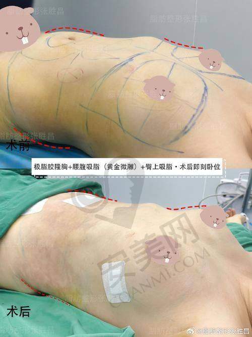 长沙艺脂自体脂肪丰胸的技术特色是什么？