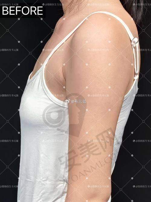 脂肪隆胸会有风险吗？