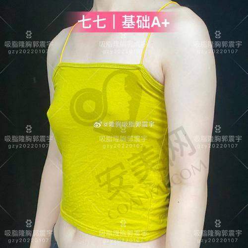 脂肪隆胸的成效如何确保？