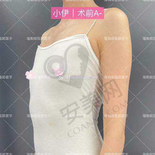 长沙艺脂医院脂肪隆胸价格分阶情况
