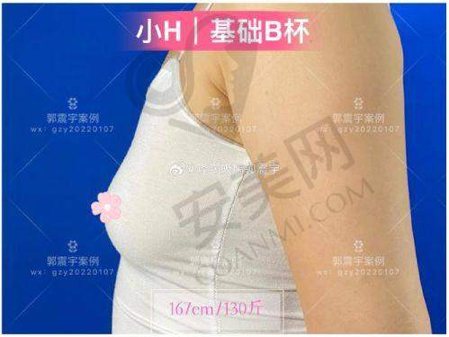 为什么选择长沙艺脂进行自体脂肪丰胸？