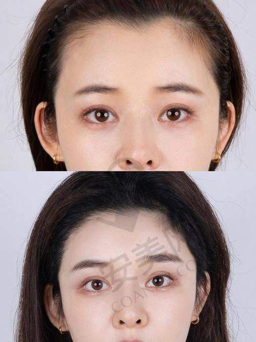如何选择适合自己的植发方案？