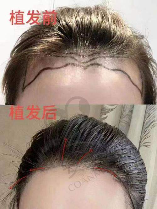 成都恒博植发医院种植发际线价格是怎样构成的？