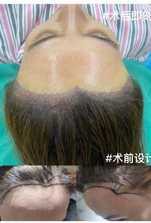 成都恒博植发医院种植发际线的成效能维持多久？
