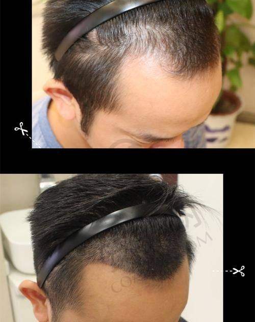在成都恒博植发医院种植发际线有哪些优势？