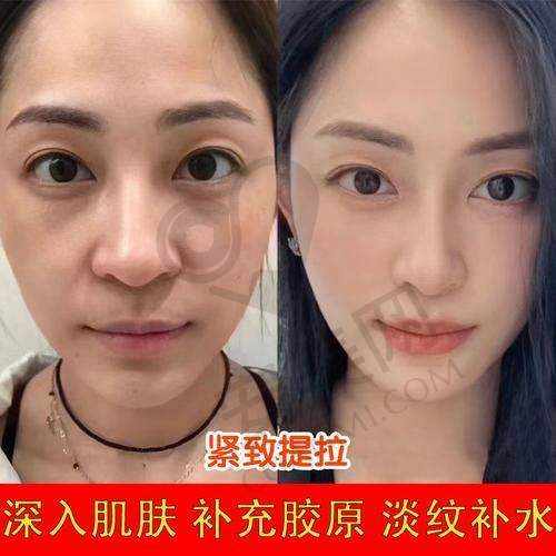 选择哈尔滨艺星医院紧肤除皱有哪些优势？
