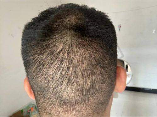 患者在成都恒博植发医院种植发际线的体验如何？