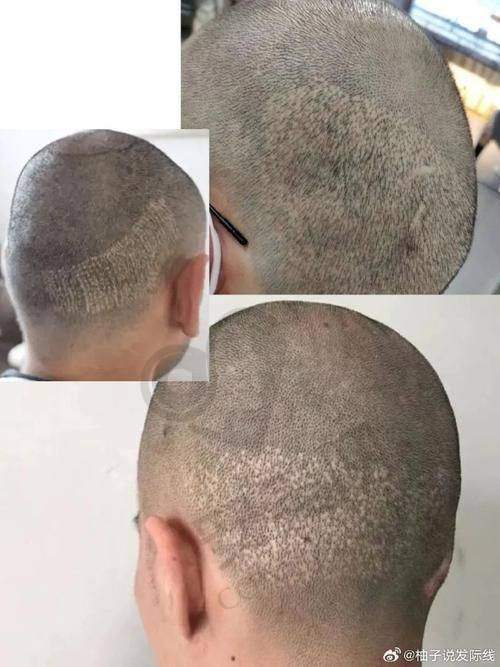 成都恒博植发医院的医生团队实力怎样？