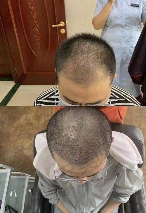 成都恒博植发医院种植发际线技术如何？
