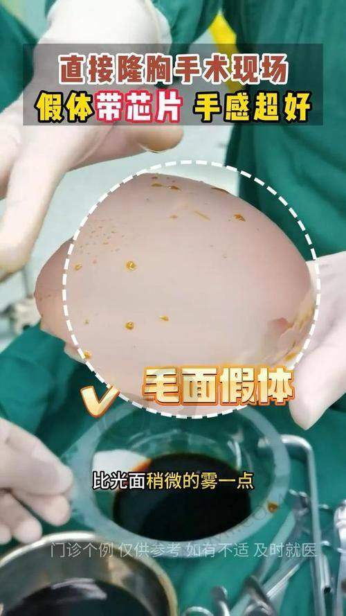 珠海韩妃医院假体隆胸术后成效能维持多久？