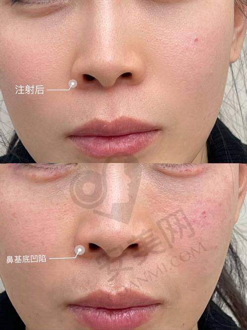 填充后的即时成效如何？