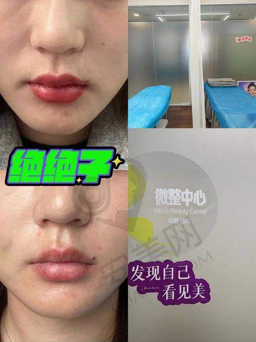 玻尿酸填充鼻基底的成效能维持多久？