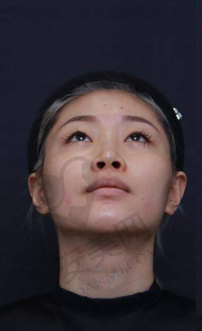 哈尔滨艺星玻尿酸填充鼻基底技术的特色在哪里？