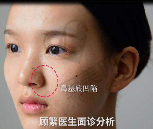 玻尿酸填充鼻基底的过程疼不疼？