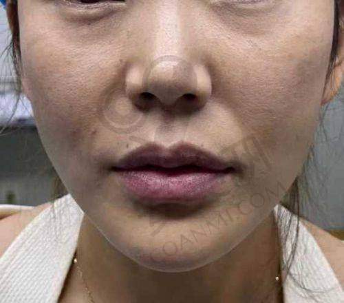 为什么选择哈尔滨艺星进行玻尿酸填充鼻基底？