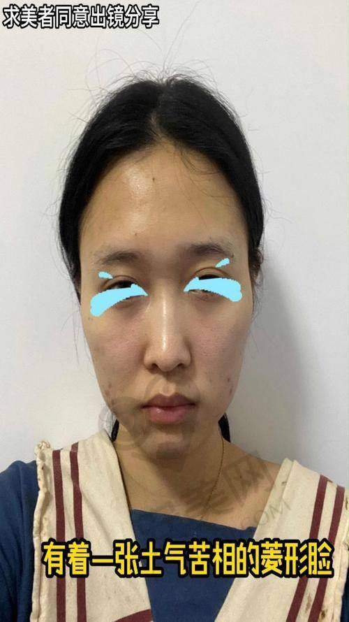 广州广大整形医院颧骨内推的手术过程是怎样的？