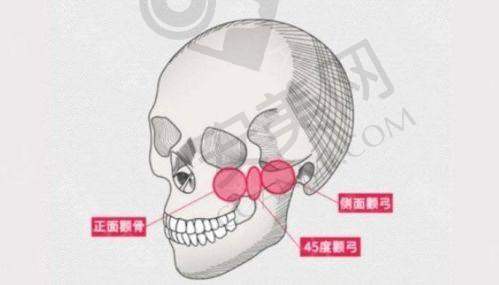 广州广大整形医院颧骨内推术后需要注意什么？