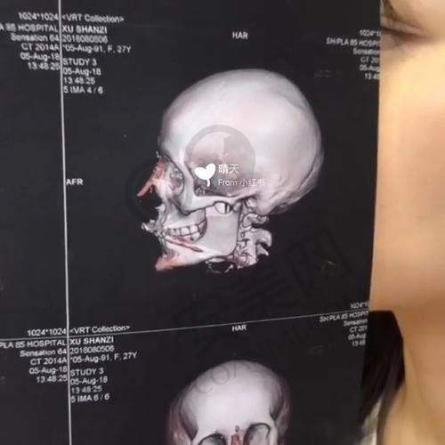 广州广大整形医院颧骨内推的价格是如何确定的？