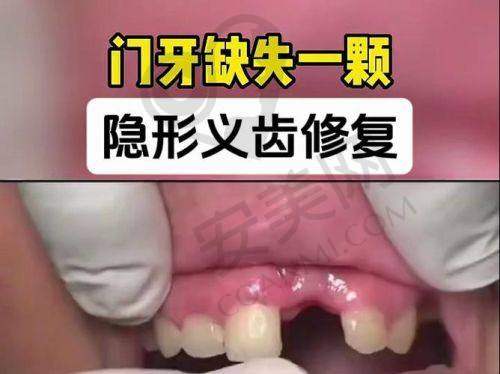 佩戴假牙：适应与调整