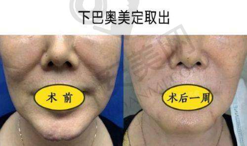 取奥美定后患者能获得怎样的成效？