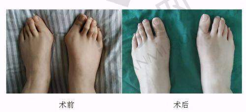 佛山曙光金子医院的双眼皮手术医生团队水平怎样？