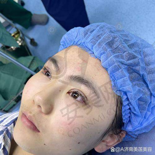 刘志刚：技术精湛，打造自然双眼皮