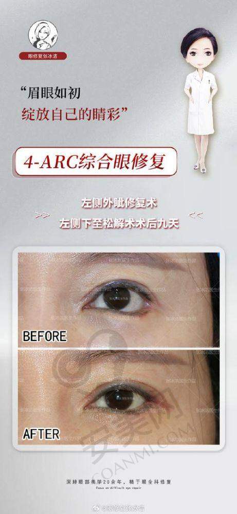 双眼皮修复：失败后的救赎