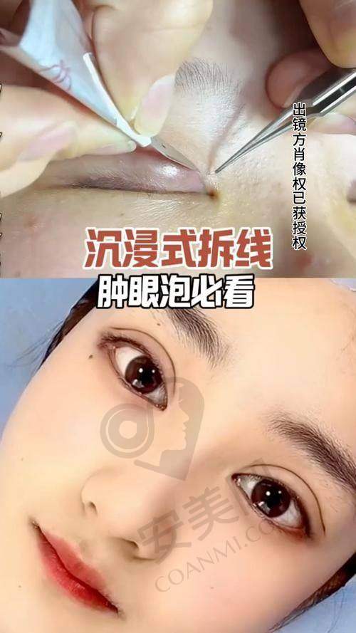 实例二：多眼皮修复——修复对称之美