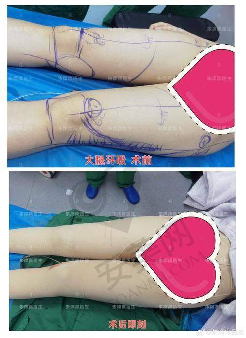 脂管加大腿吸脂是什么？