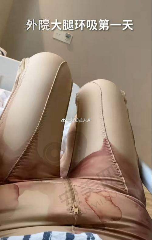 为什么选择泉州的医美机构进行脂管加大腿吸脂？