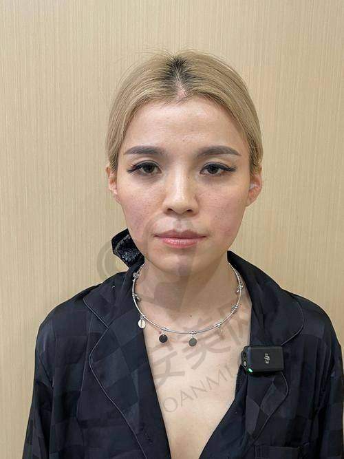 进口硅胶假体
