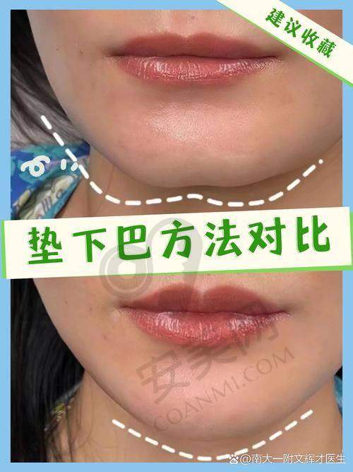 玻尿酸注射下巴有哪些风险和并发症？