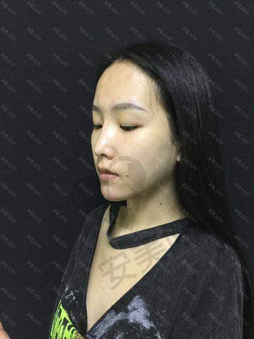 玻尿酸注射下巴术后需要注意什么？