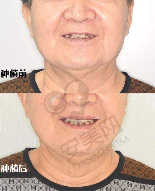 半口种植牙的成效能维持多久？