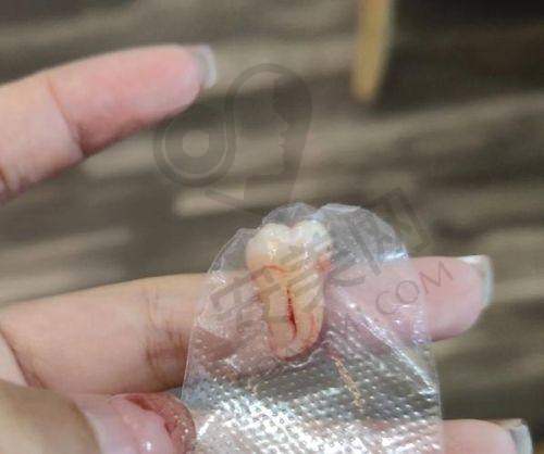 拉萨雅博仕口腔智齿拔除技术有什么特色？