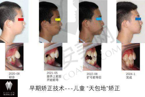 海口植之道口腔儿童早期干预矫正的成效如何？