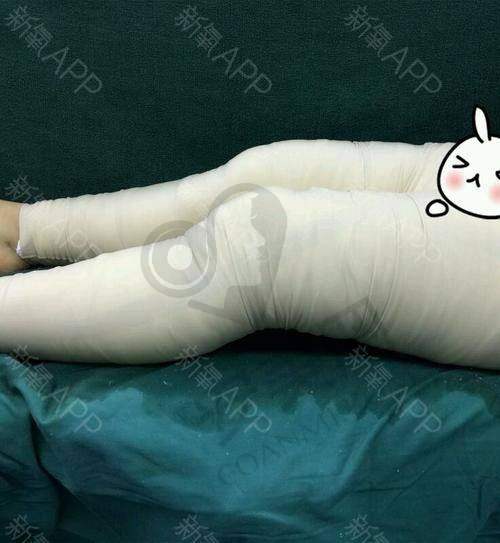 脂管加大腿吸脂有哪些优势？