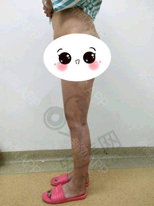 脂管加大腿吸脂后需要注意什么？
