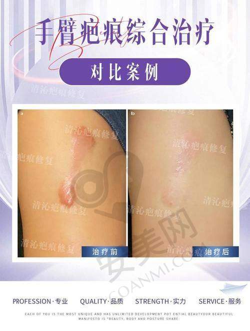 第2名：上海虹桥医院疤痕科