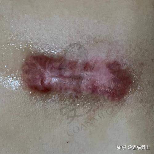 什么是疤痕疙瘩，为何令人困扰？