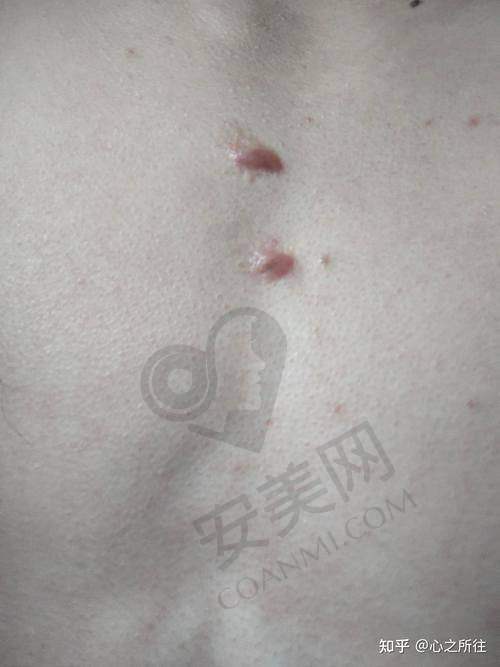 取疤痕疙瘩13800元起的价格是如何确定的？