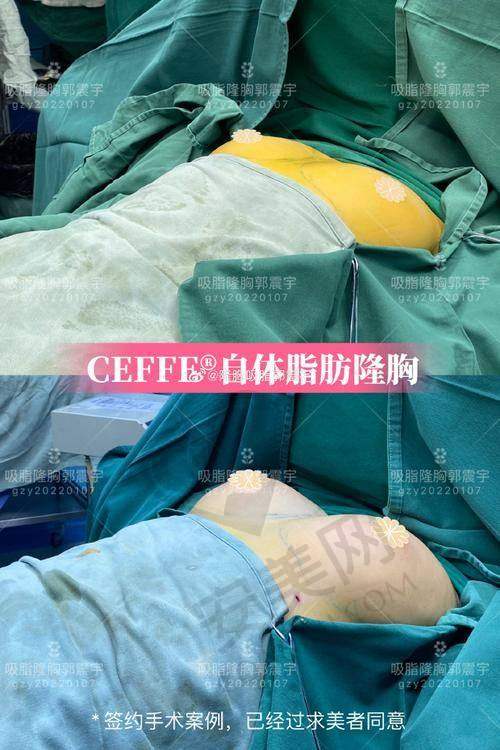 如何选择泉州脂管加自体脂肪丰胸的医院和医生？