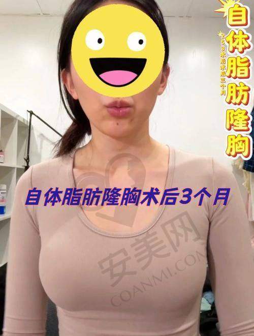 泉州脂管加自体脂肪丰胸的成效和感受如何？