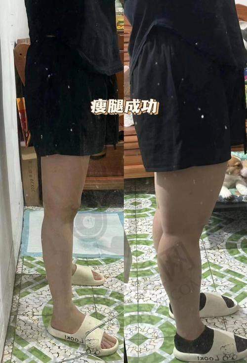 直腿术：医美界新宠的魅力所在