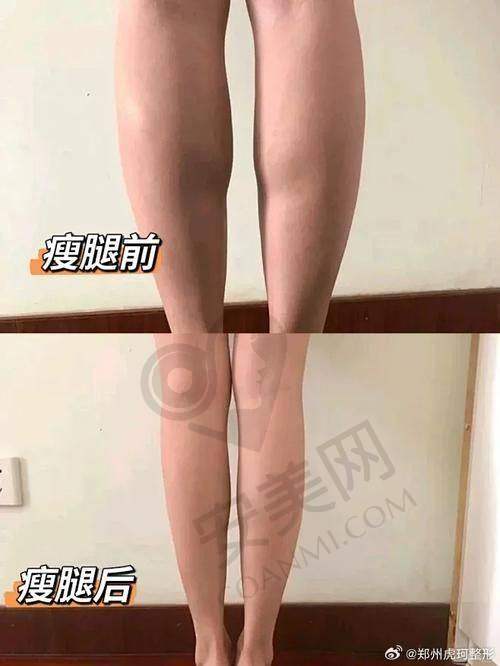 北京樱桃腿型矫正值得尝试吗？