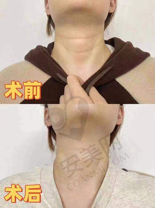 上海江城皮肤医院嗨体去颈纹的成效如何？